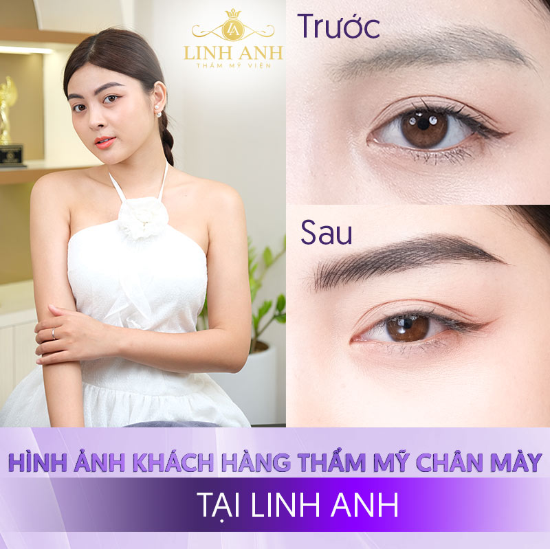 phương pháp thẩm mỹ chân mày