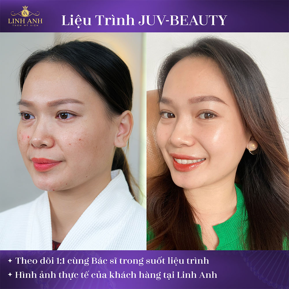 Kết quả khách hàng nhận được sau khi sử dụng liệu trình trẻ hóa da JUV Beauty