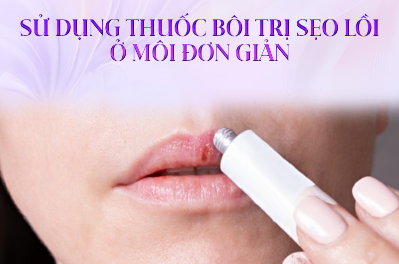 Sử dụng thuốc bôi trị sẹo lồi ở môi đơn giản.