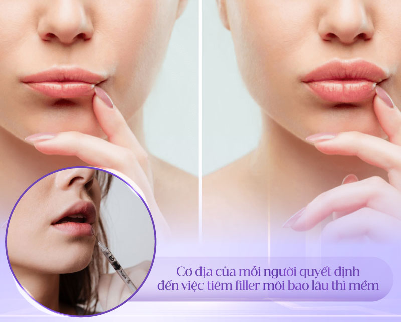 Cơ địa của mỗi người quyết định đến việc tiêm filler môi bao lâu thì mềm