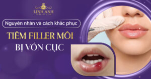 tiêm filler môi bị vón cục