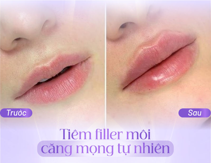 Lựa chọn địa chỉ tiêm filler môi an toàn, không ảnh hưởng sức khỏe.