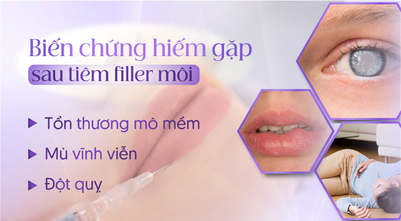 tiêm filler môi có nguy hiểm không