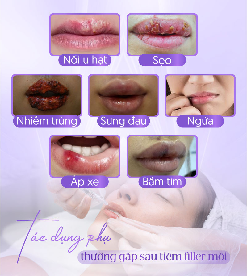 tiêm filler môi có tác dung phụ không