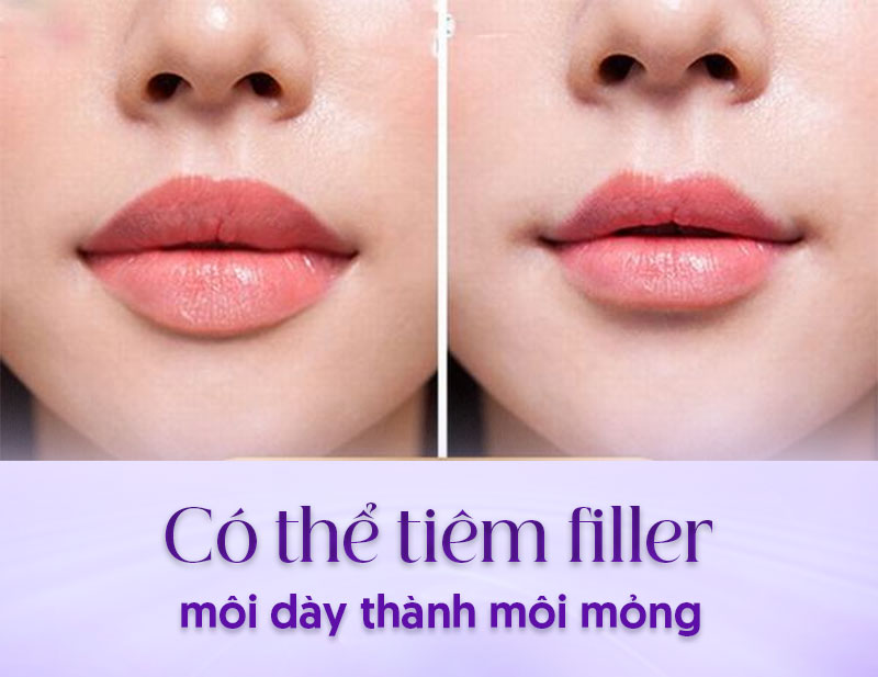 tiêm filler môi dày thành mỏng