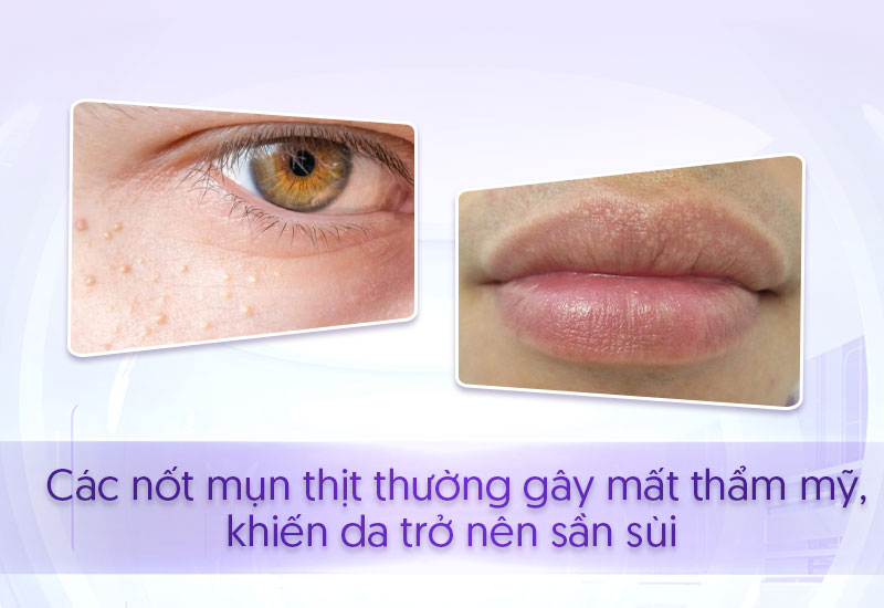 trị mụn thịt ở môi giá bao nhiêu