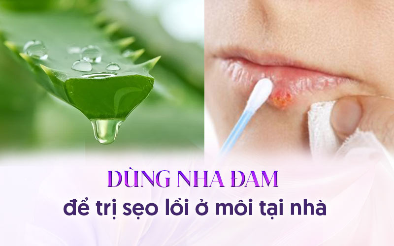 Trị sẹo lồi mới hình thành ở môi với nha đam.