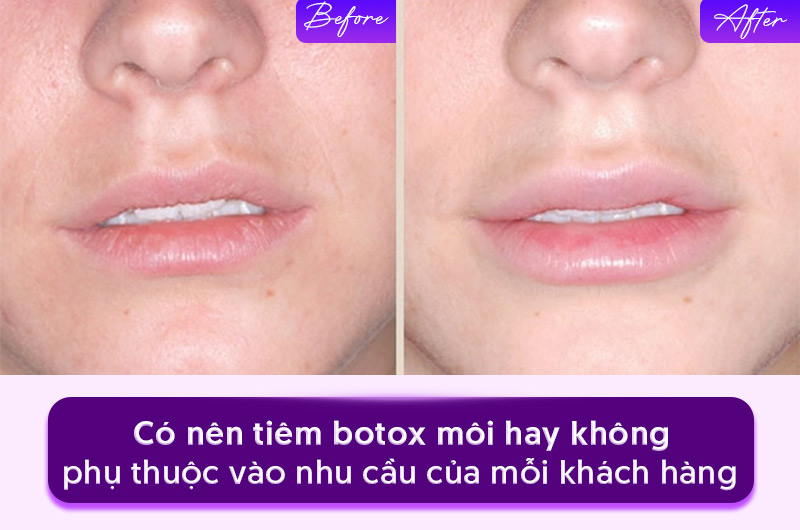 ưu và nhược điểm của tiêm botox môi