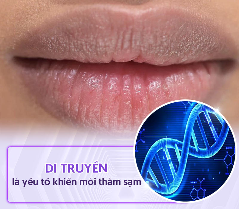 Vì sao môi bị thâm đen? Nguyên nhân có thể là do di truyền.