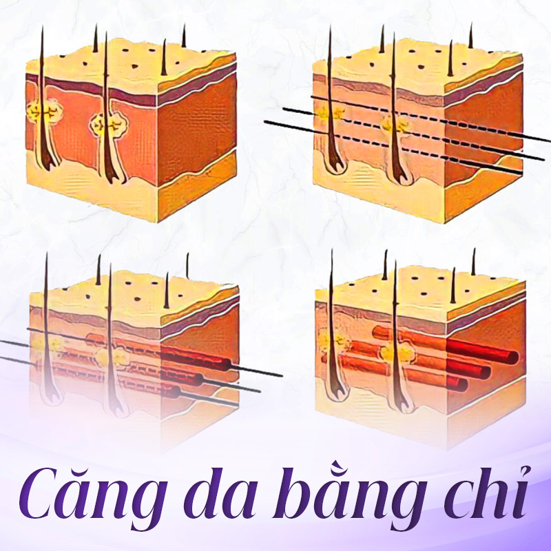 căng chỉ trán