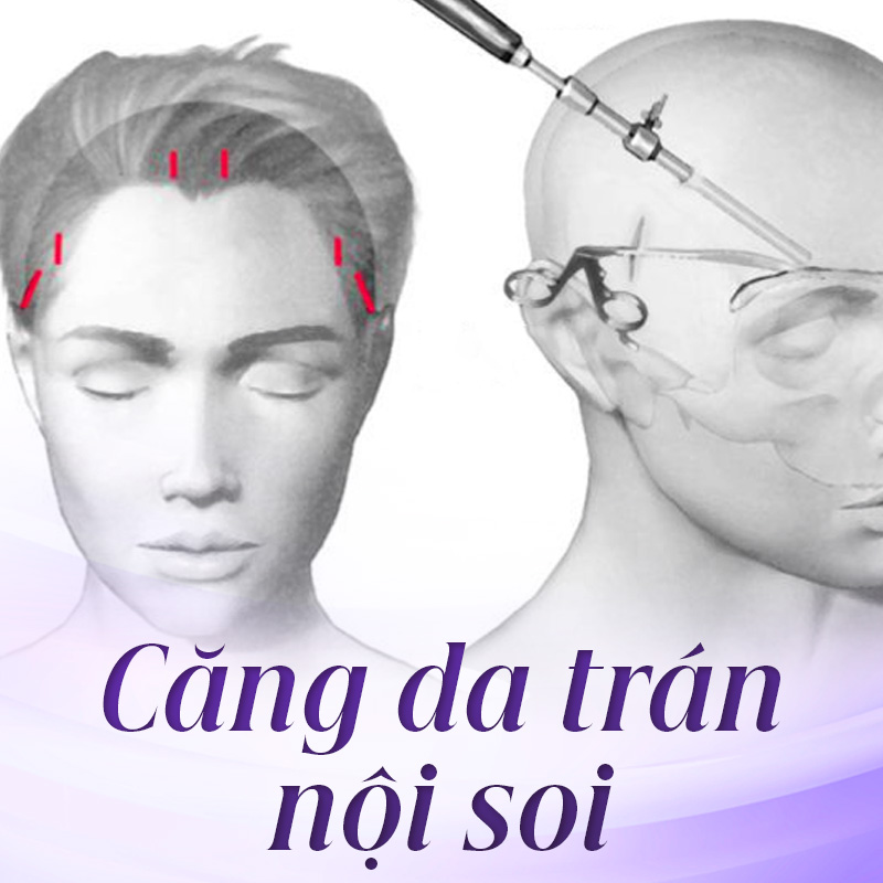 dịch vụ căng da trán