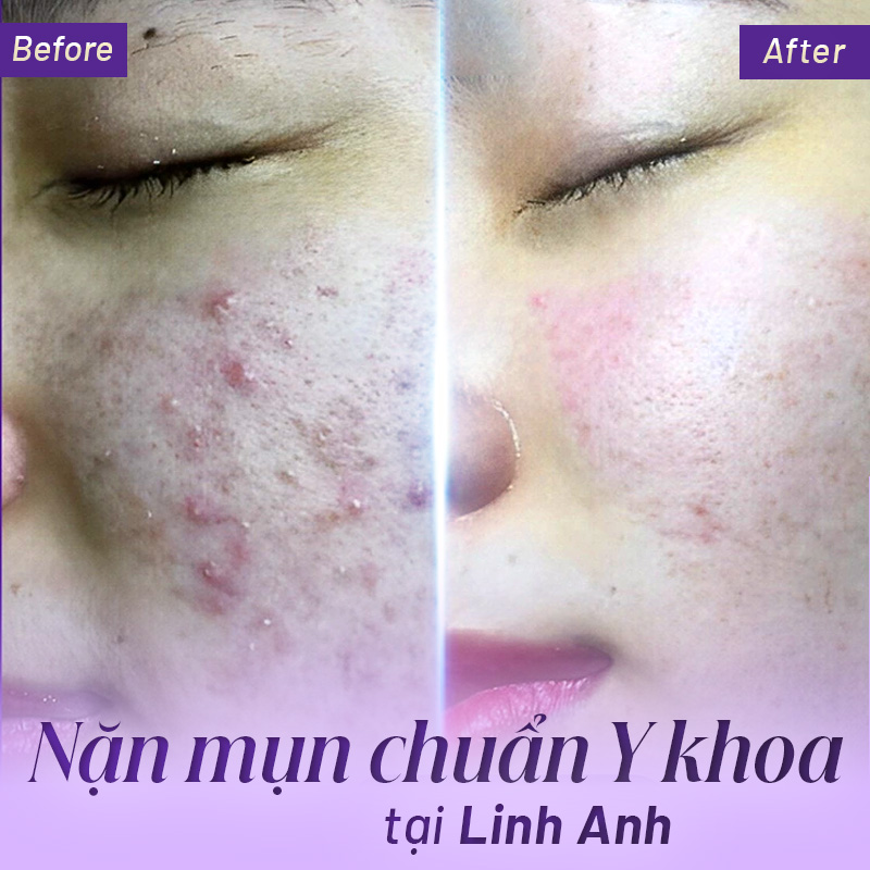 lấy mụn giá bao nhiêu