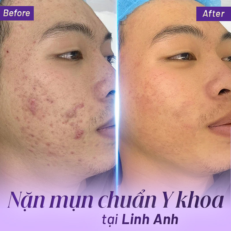 lấy nhân mụn hết bao nhiêu tiền