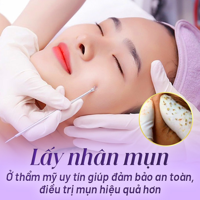 nặn mụn giá bao nhiêu