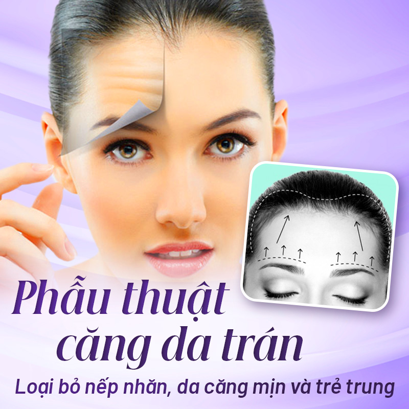 phẫu thuật căng da trán