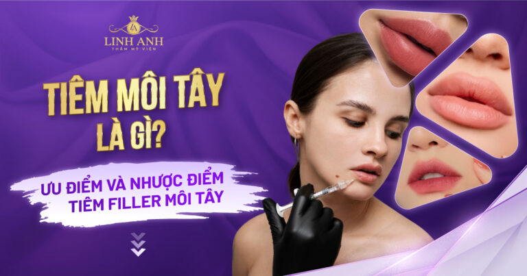 Tiêm môi tây là gì? Ưu và nhược điểm tiêm filler môi tây