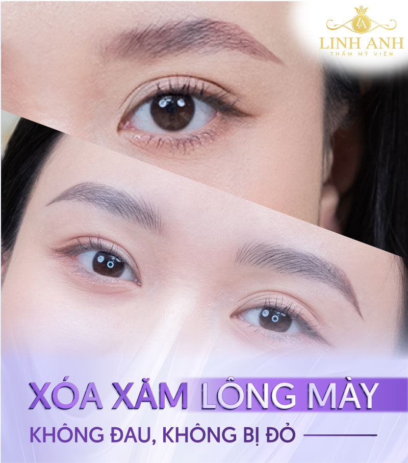 bắn laser lông mày bị đỏ