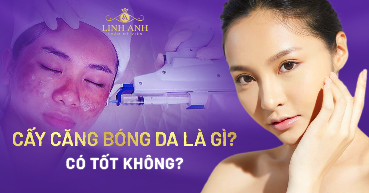 Cấy căng bóng da có tốt không? Duy trì được bao lâu?