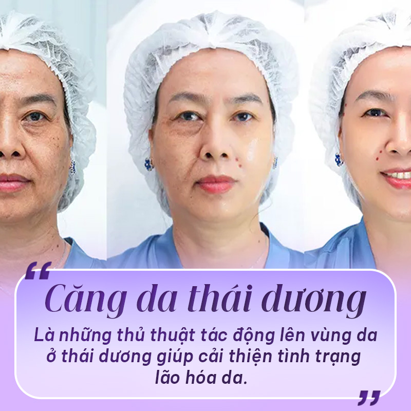 căng da thái dương hiệu quả