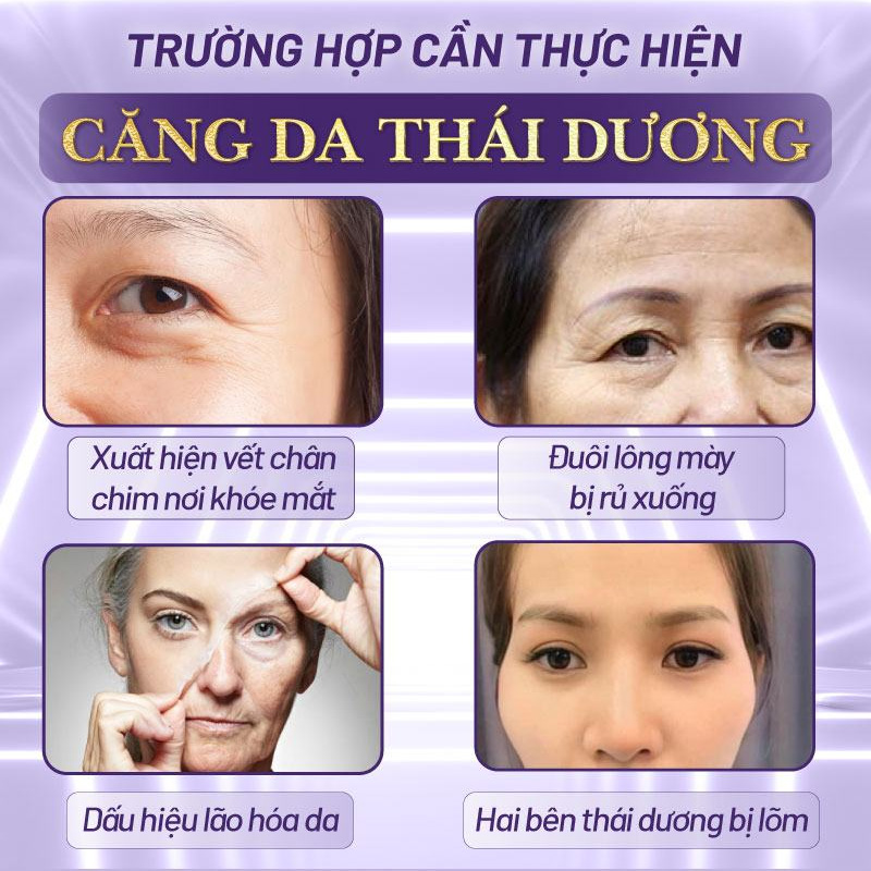 căng da thái dương là gì