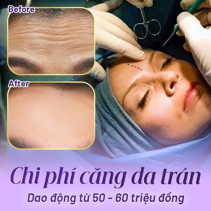 căng da trán tại Linh Anh