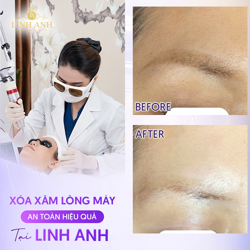 chi phí xóa xăm chân mày bằng laser