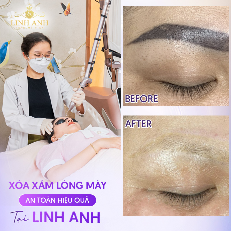 giá xóa xăm chân mày bằng laser