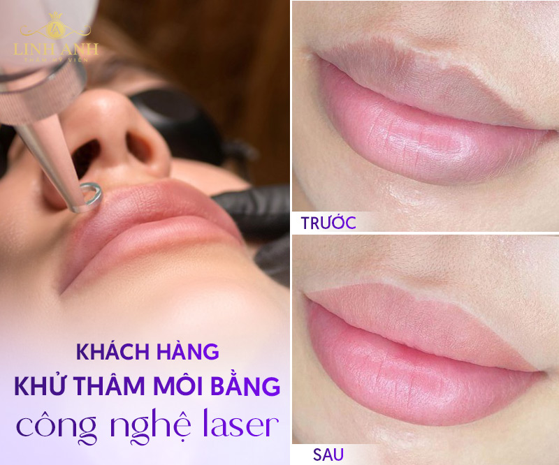 khử Thâm môi kiêng ăn bao lâu