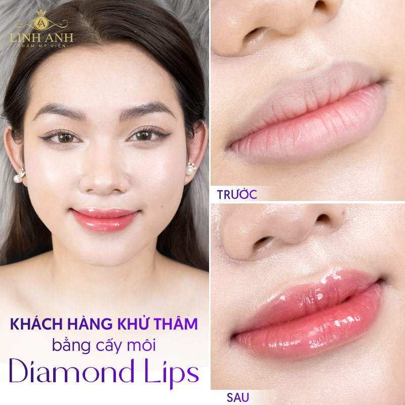 khử Thâm môi nên kiêng gì để mau lành