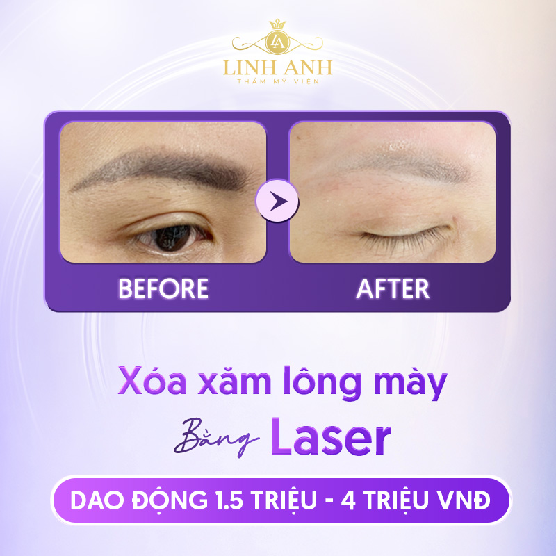 xóa xăm chân mày bằng laser bao nhiêu