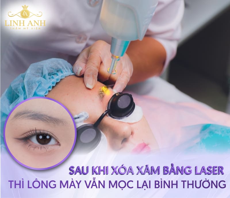 xóa xăm lông mày bao lâu làm lại được