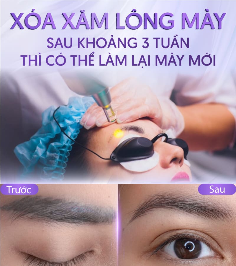 xoá xăm lông mày bao lâu thì làm lại được