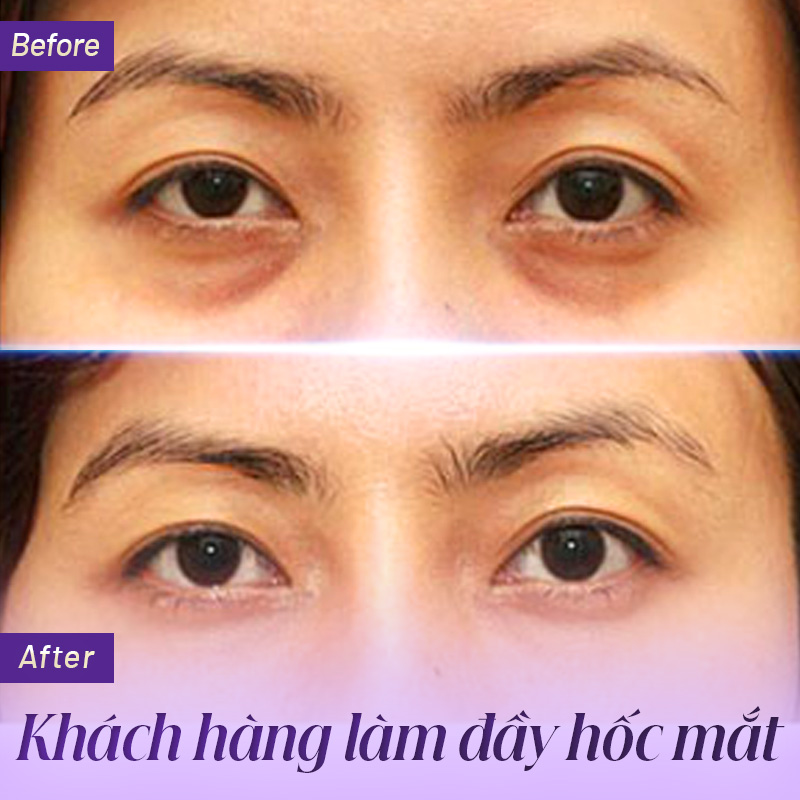 Giá tiêm filler hốc mắt