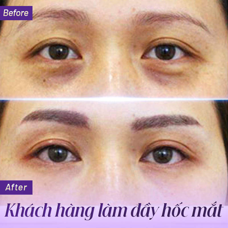 Tiêm filler làm đầy hốc mắt giá bao nhiêu