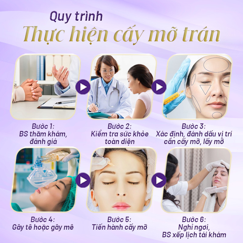 cấy mỡ lên trán