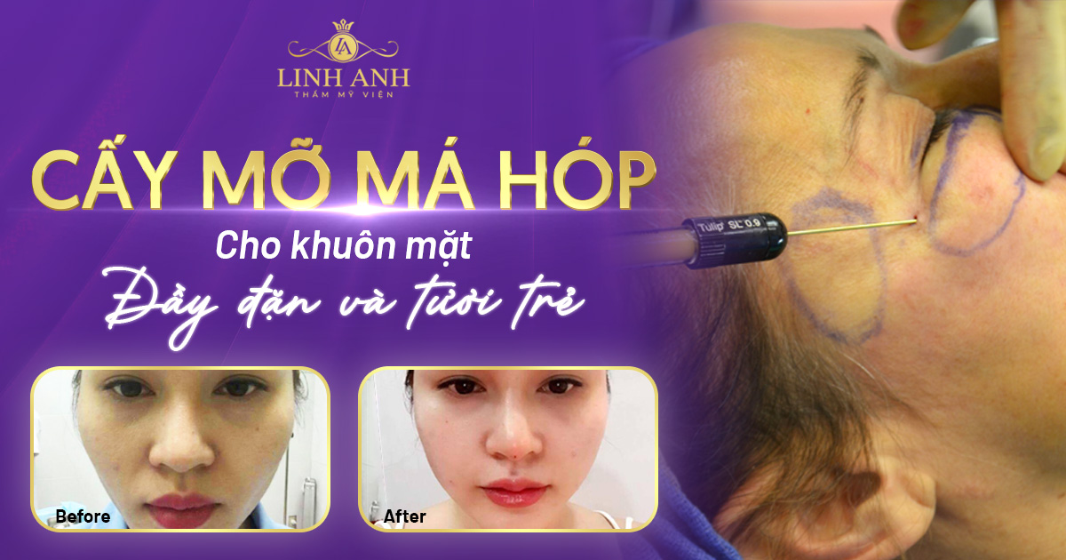 Cấy mỡ má hóp cho khuôn mặt đầy đặn, tươi trẻ