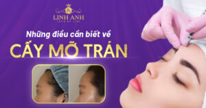 cấy mỡ trán