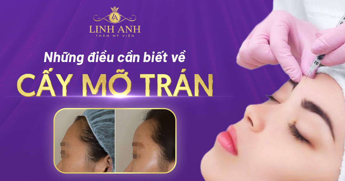 cấy mỡ trán