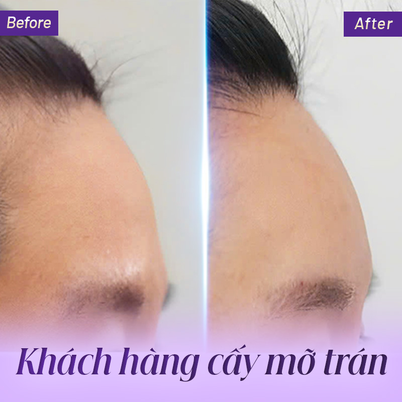 cấy mỡ trán giá bao nhiêu