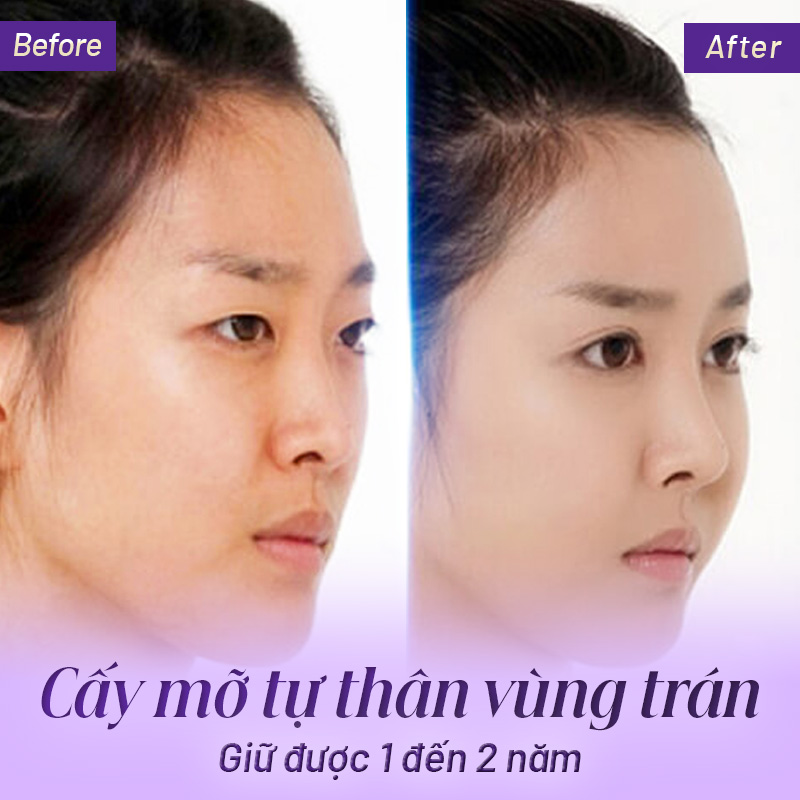 cấy mỡ trán giữ được bao lâu