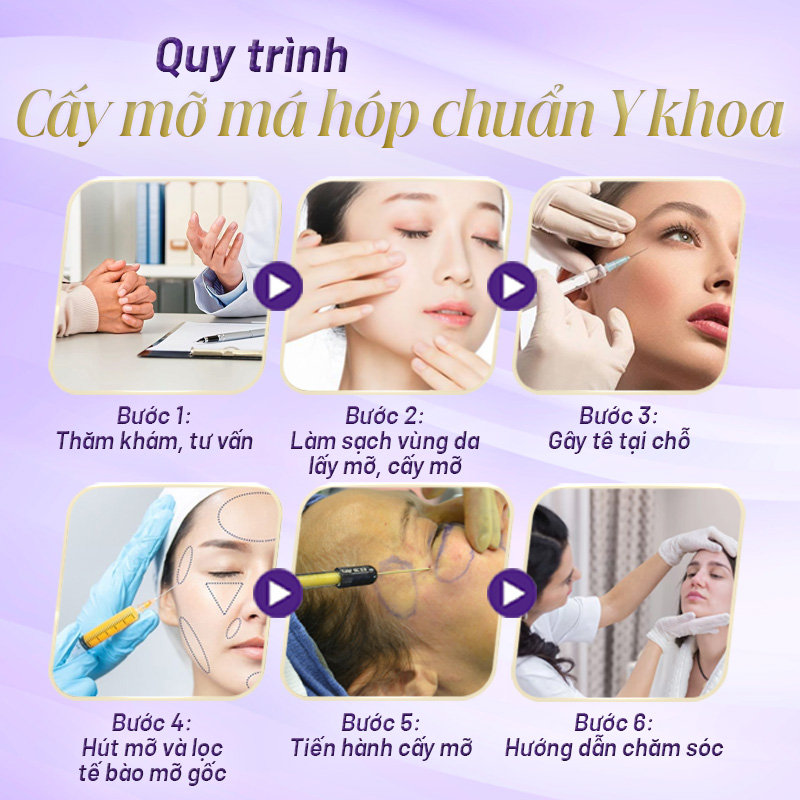 cấy mỡ tự thân lên gò má bị hóp