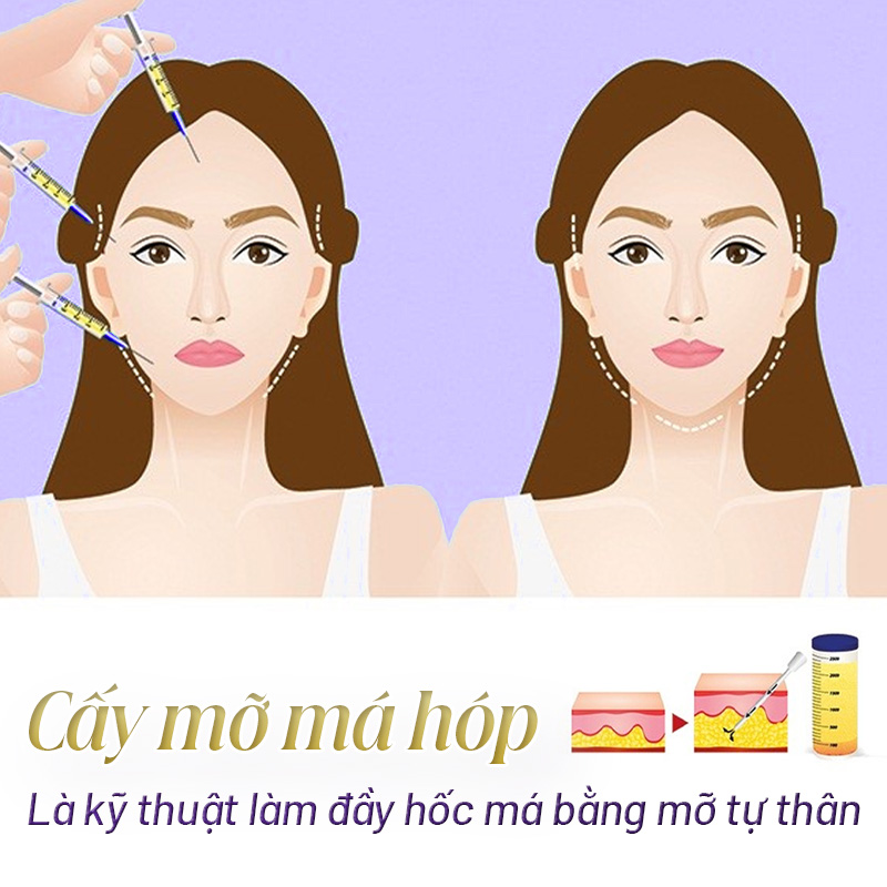 cấy mỡ tự thân lên má