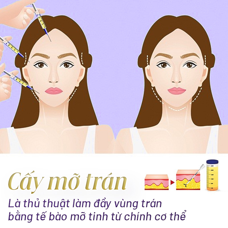 cấy mỡ tự thân vùng trán