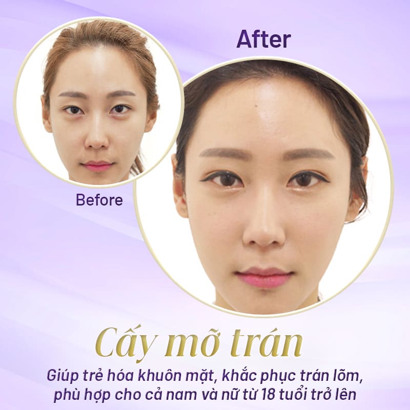 cấy mỡ vùng trán