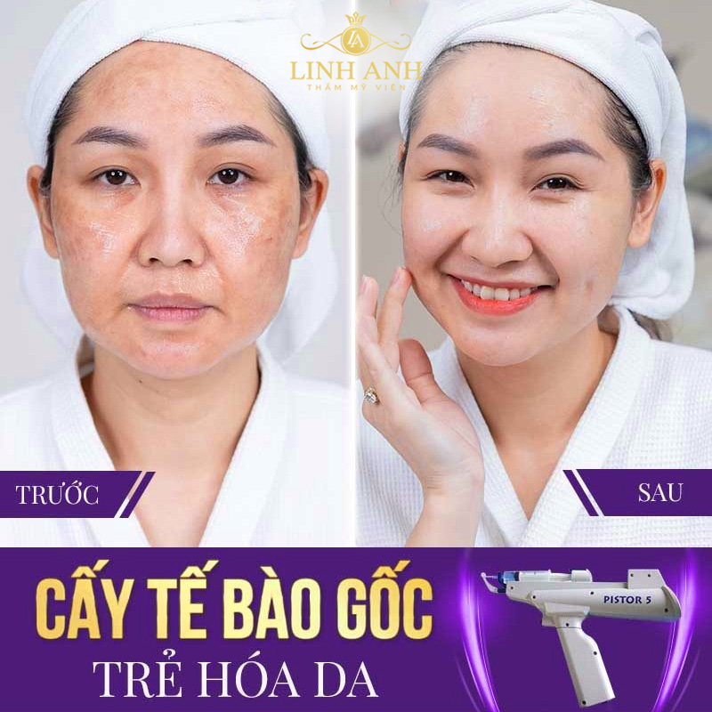 cấy tế bào gốc cho da mặt giá bao nhiêu