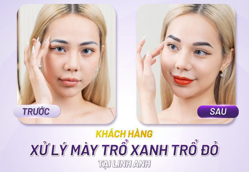 chân mày bị trổ xanh trổ đỏ