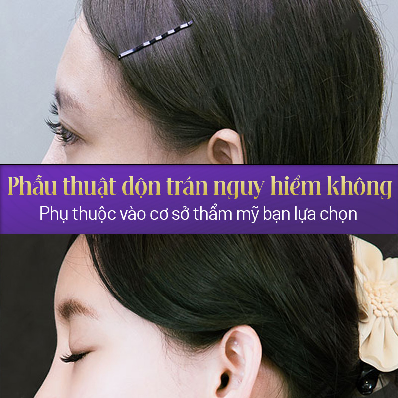 chi phí độn trán