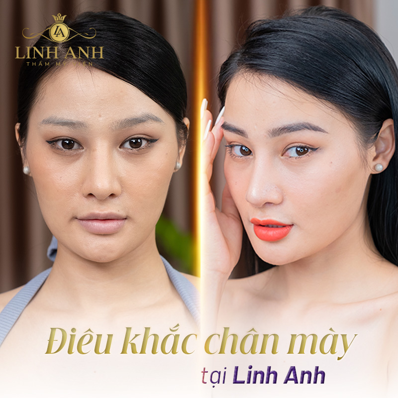 dáng lông mày đứt đoạn - Viện thẩm mỹ quốc tế Linh Anh