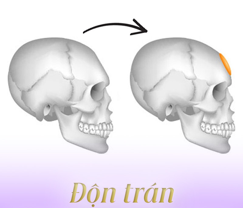 dịch vụ độn trán