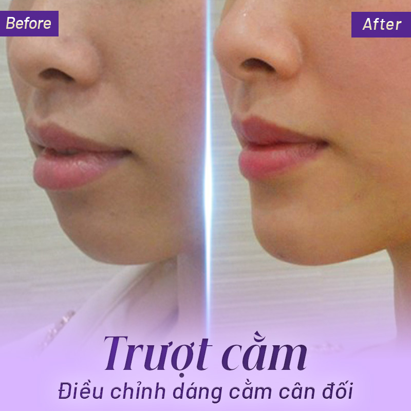 dịch vụ trượt cằm